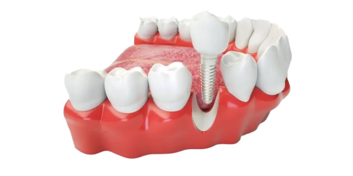 Is All-on-4 Brisbane a Permanent Tooth Replacement Solution?