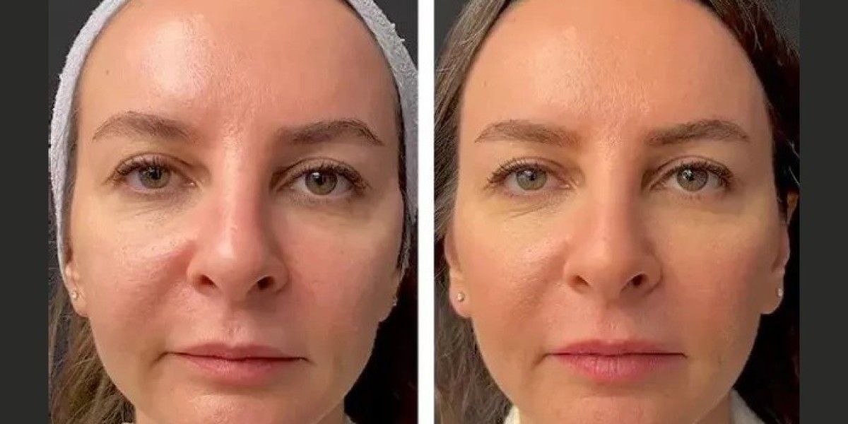 Best Doctors in Dubai: Mesotherapy Aftercare and Recovery Tips
