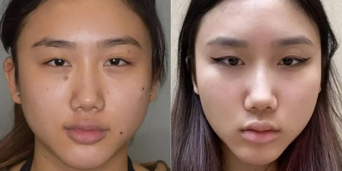 Buccal fat removal in Dubai Facial Refinement