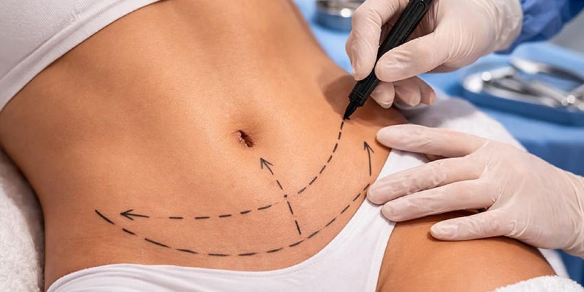 Liposuction in Islamabad: Understanding the Science Behind Fat Removal