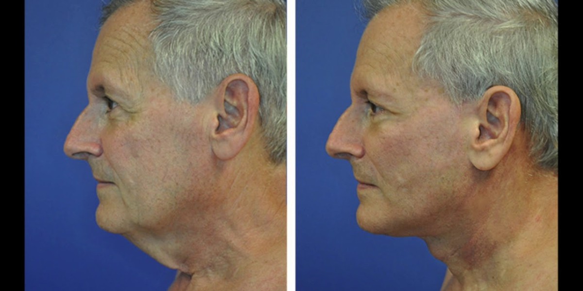 Neck Lift Surgery in Dubai: Recovery Timeline