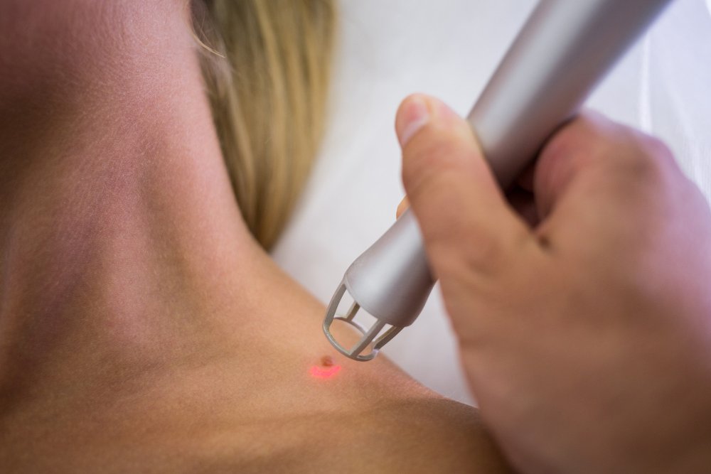 Laser Tattoo Removal in Chandigarh | Cosmo Care & Hair Clinic