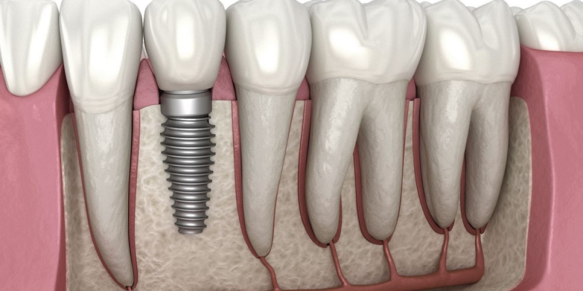 Dentist Near Me for Dental Implants: Your Guide to Replacing Missing Teeth