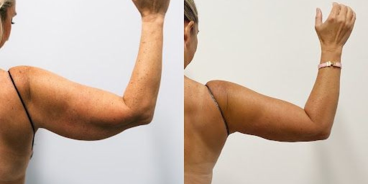 Arm Lift Surgery in Dubai: Recovery Expectations