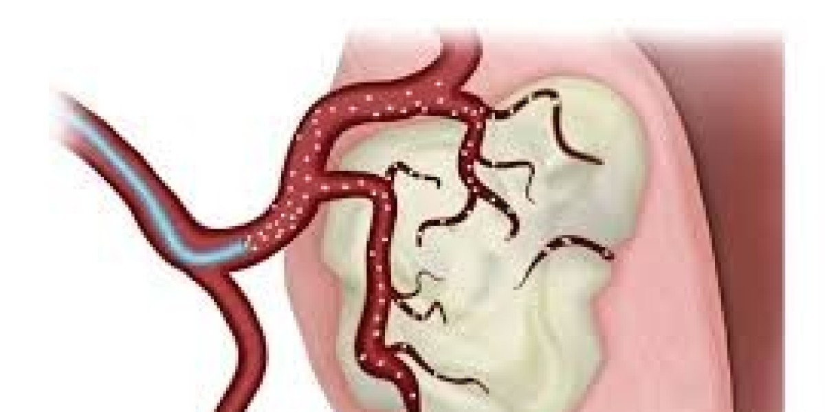 Your Guide to a Comfortable Uterine Fibroid Embolization Recovery