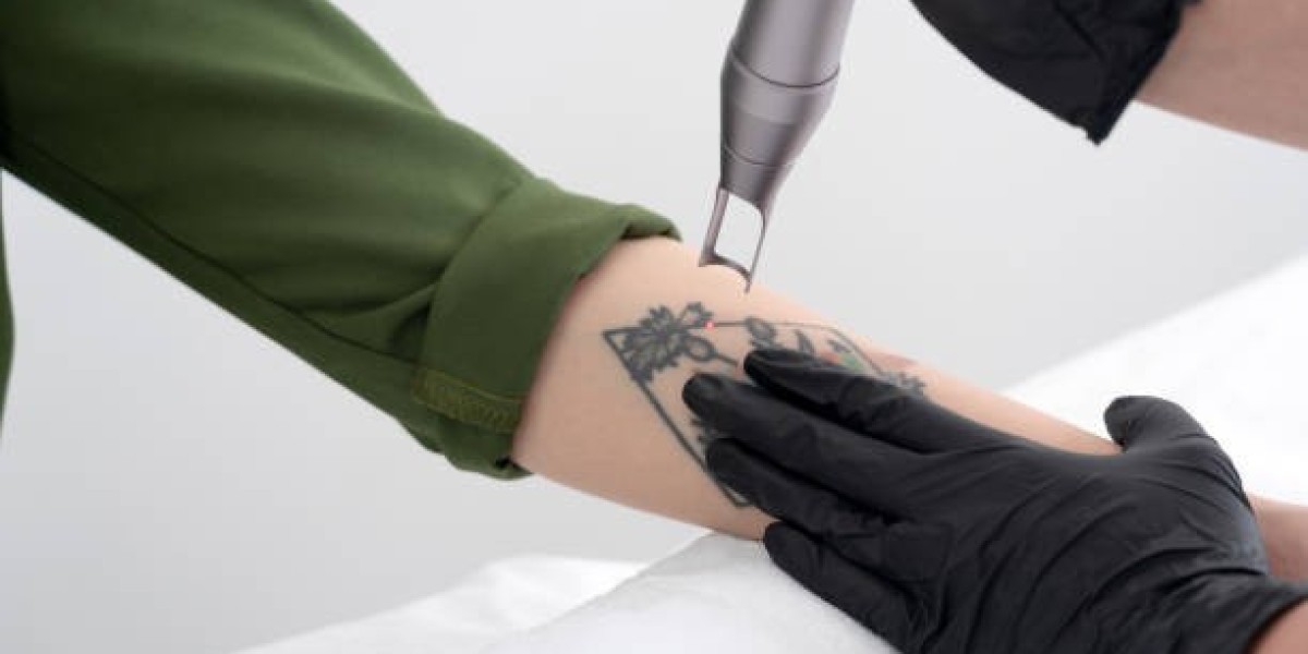 How Tattoo Age Can Affect Laser Tattoo Removal Results