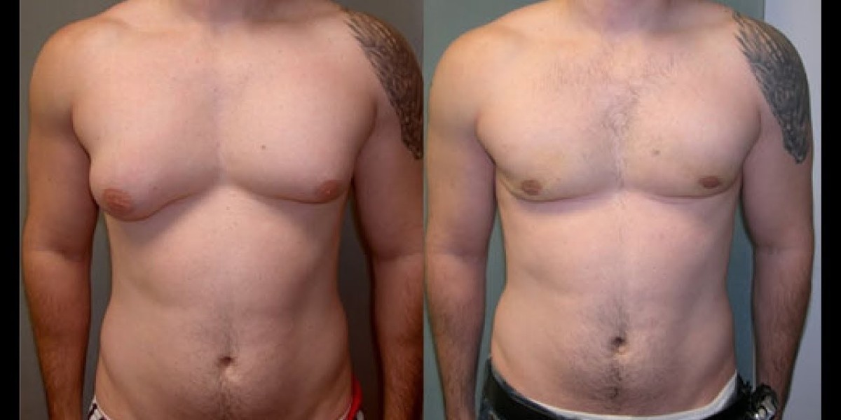 Gynaecomastia Surgery in Dubai: Procedure Insights