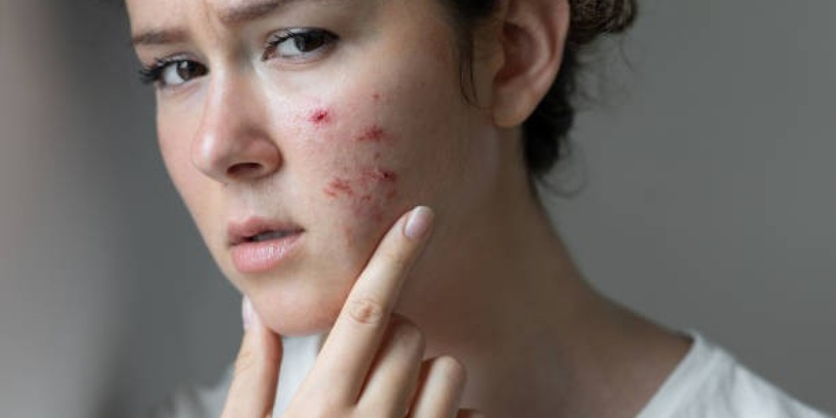 Acne Scar Treatment in Riyadh: A Complete Guide to Clearer Skin