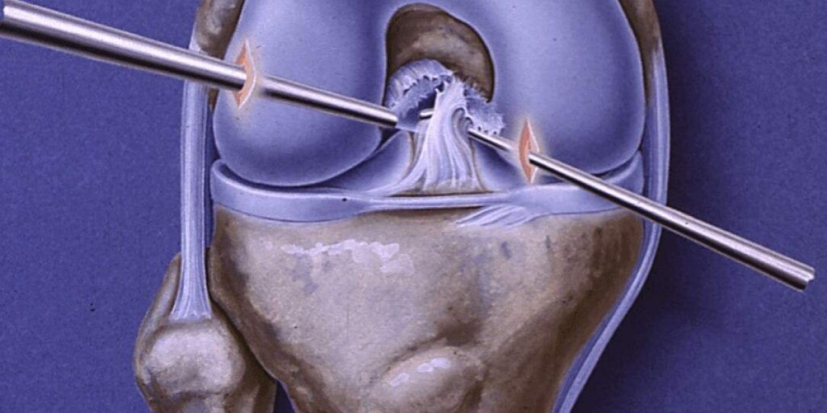 Ligament Surgery in Indore: Treatment, Procedure & Recovery
