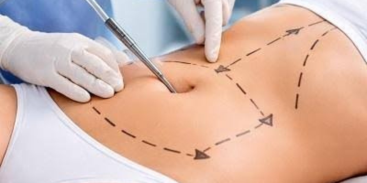 Tummy Tuck In Dubai: Sculpt Your Abdomen for a Defined Look