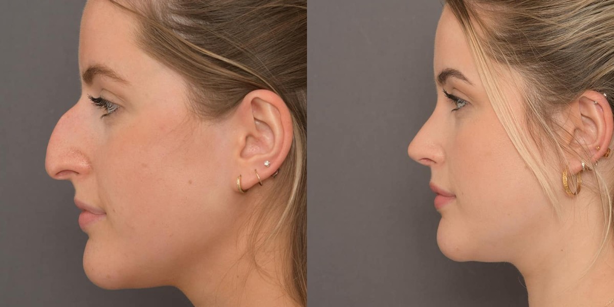 Rhinoplasty in Islamabad: How Surgeons Assess Facial Symmetry Before Surgery